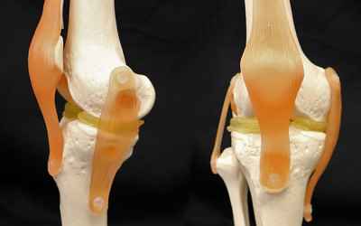 3-D-Printable Implants May Ease Damaged Knees