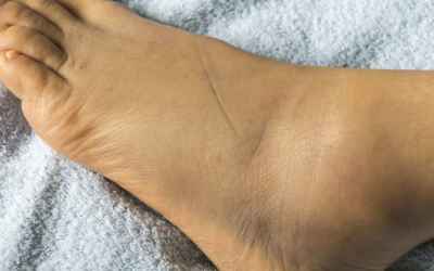 Swollen feet: 15 causes, treatments, and home remedies